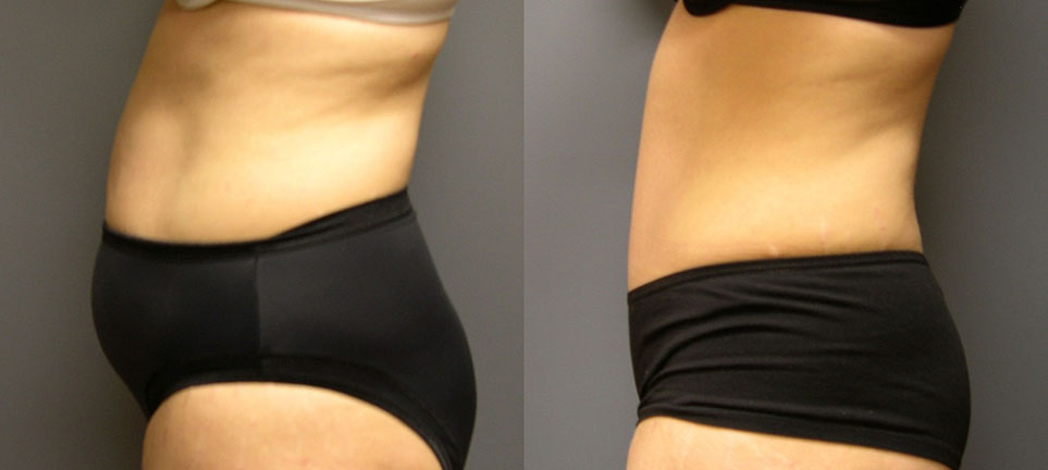 Liposuction in Dubai